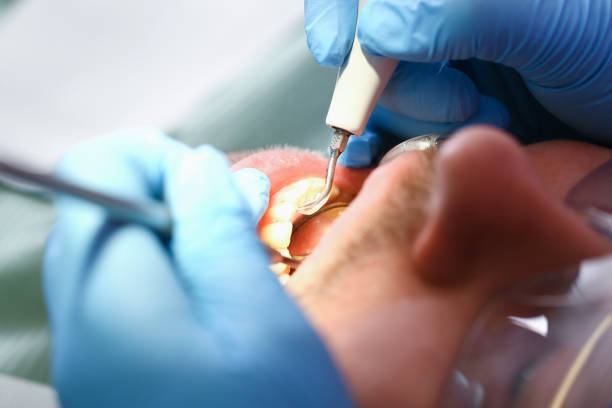 Best Emergency Dental Extractions in Scissors, TX
